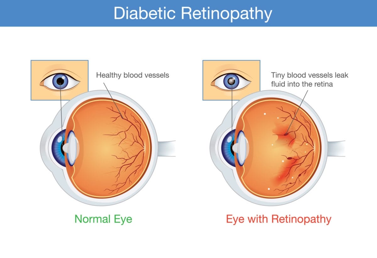 Diabetic Retinopathy: Early Signs, Stages & Best Treatment in Hyderabad